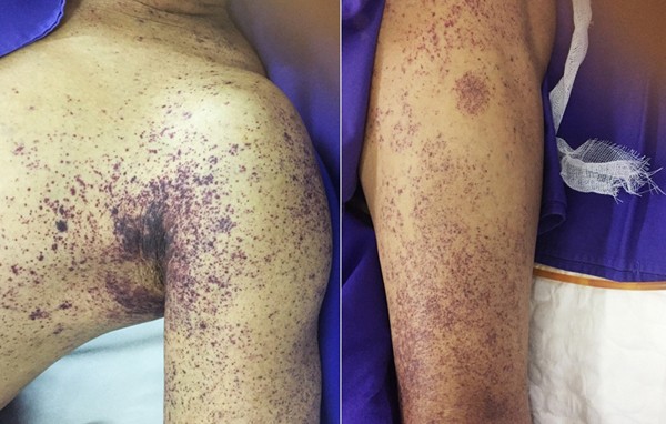 Ăn tiết canh giải đen cuối năm, 1 quý ông mất mạng