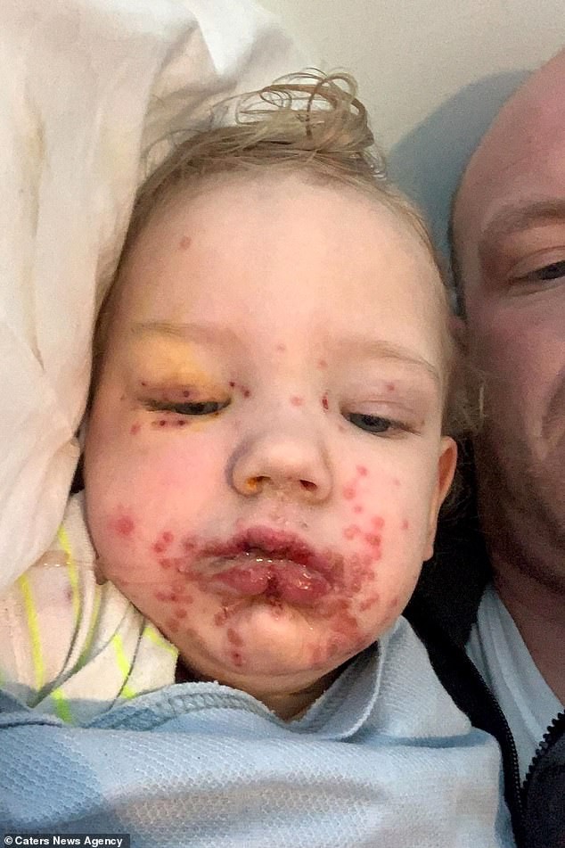 Kalo Hoy, now two, spent four days in hospital last month after his parents, Lorna Hoy, 27, and Andy Briggs, 34, noticed small red spots forming across his face, chest and arm