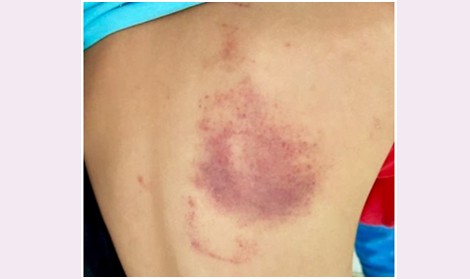 Xử phạt 5 triệu đồng cô giáo đánh học sinh bầm lưng ảnh 1