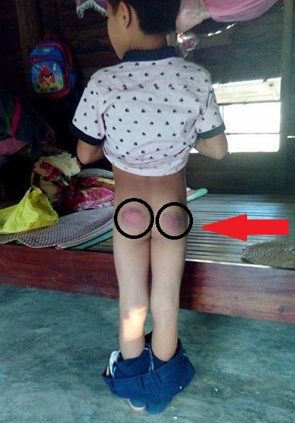 Dân mạng phẫn nộ cô giáo đánh tím mông học sinh vì không làm bài ảnh 1