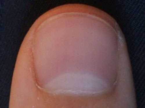 Móng tay có hình trăng lưỡi liềm: Dấu hiệu bệnh tật ảnh 1