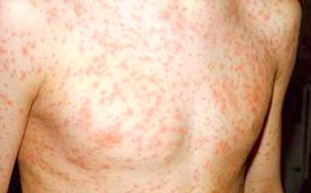 Dấu hiệu rõ rệt cho thấy bạn đã nhiễm HIV ảnh 3