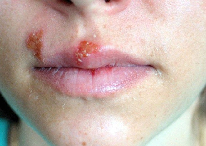 Dấu hiệu rõ rệt cho thấy bạn đã nhiễm HIV ảnh 4