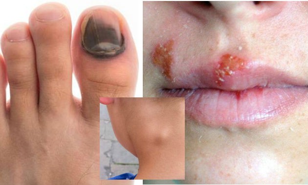 Dấu hiệu rõ rệt cho thấy bạn đã nhiễm HIV ảnh 1