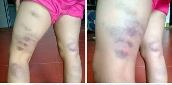 Cô giáo đánh tím chân học sinh vì viết sai một chữ ảnh 1