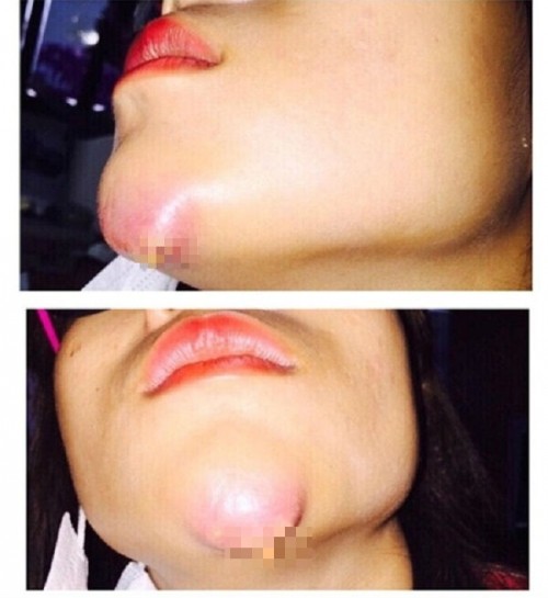 Chuộng thẩm mỹ nhiều thiếu nữ ở Hà Nội biến dạng sau một đêm ảnh 17