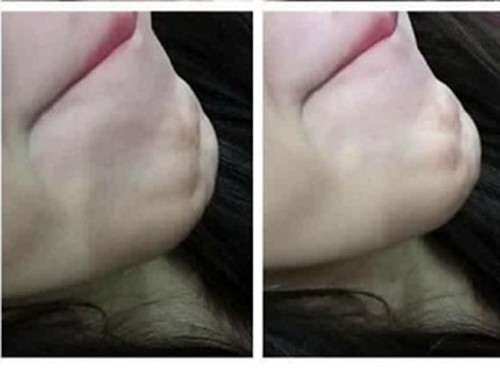 Chuộng thẩm mỹ nhiều thiếu nữ ở Hà Nội biến dạng sau một đêm ảnh 16