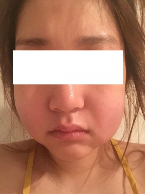 Chuộng thẩm mỹ nhiều thiếu nữ ở Hà Nội biến dạng sau một đêm ảnh 14