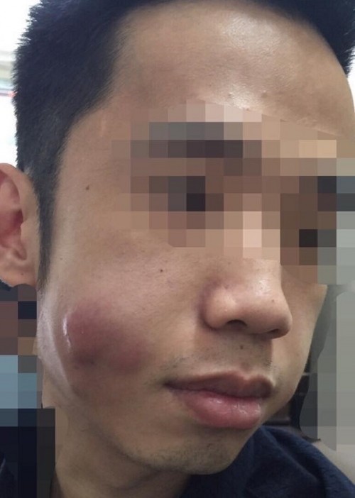 Chuộng thẩm mỹ nhiều thiếu nữ ở Hà Nội biến dạng sau một đêm ảnh 13