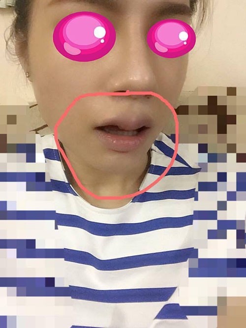 Chuộng thẩm mỹ nhiều thiếu nữ ở Hà Nội biến dạng sau một đêm ảnh 8