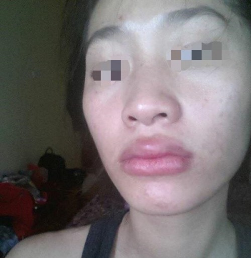 Chuộng thẩm mỹ nhiều thiếu nữ ở Hà Nội biến dạng sau một đêm ảnh 7