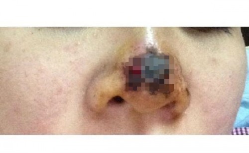 Chuộng thẩm mỹ nhiều thiếu nữ ở Hà Nội biến dạng sau một đêm ảnh 6