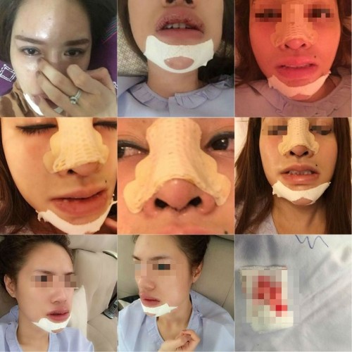 Chuộng thẩm mỹ nhiều thiếu nữ ở Hà Nội biến dạng sau một đêm ảnh 2