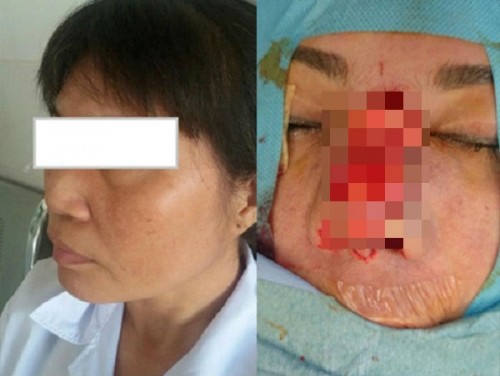 Chuộng thẩm mỹ nhiều thiếu nữ ở Hà Nội biến dạng sau một đêm ảnh 4