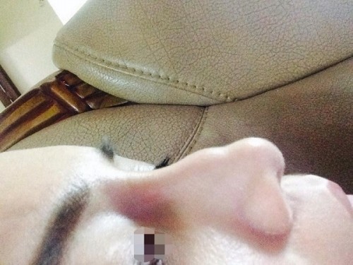 Chuộng thẩm mỹ nhiều thiếu nữ ở Hà Nội biến dạng sau một đêm ảnh 5