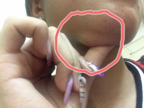 Chuộng thẩm mỹ nhiều thiếu nữ ở Hà Nội biến dạng sau một đêm ảnh 10