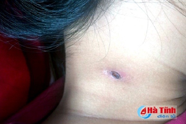 Bệnh lạ xuất hiện ở Hà Tĩnh có thể gây chết người ảnh 1