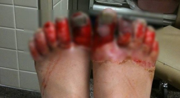 Cảnh báo có thể hoại tử chi, mất chân vì nhiễm lạnh ảnh 1