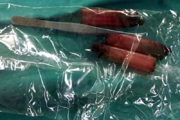 Chồng nuốt chửng nhíp và 3 chiếc bật lửa vào bụng vì giận vợ ảnh 1