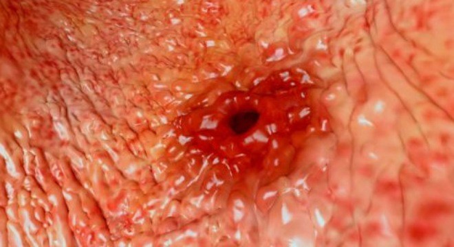 Bài thuốc chữa bệnh viêm loét dạ dày trong vòng 1 tuần ảnh 1