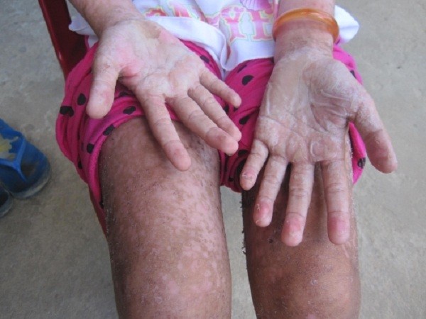 Bé gái bị bỏng rộp toàn thân, suýt chết vì uống nước ngọt? ảnh 1