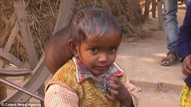 Xót thương trước hình ảnh cô bé 'hai đầu' ở Ấn Độ ảnh 2