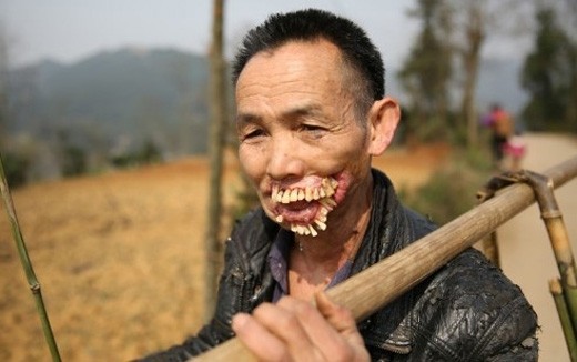 Kinh hãi khuôn mặt người đàn ông biến dạng vì chó sói cắn ảnh 1