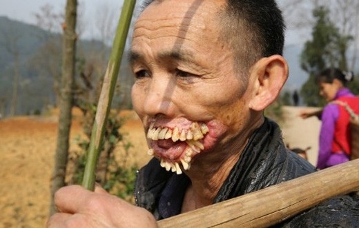 Kinh hãi khuôn mặt người đàn ông biến dạng vì chó sói cắn ảnh 2