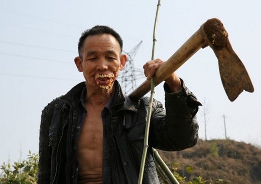 Kinh hãi khuôn mặt người đàn ông biến dạng vì chó sói cắn ảnh 4