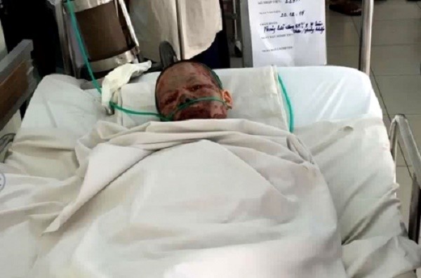 Thiếu nữ xinh đẹp bị người yêu cũ tạt xăng châm lửa đốt ảnh 1