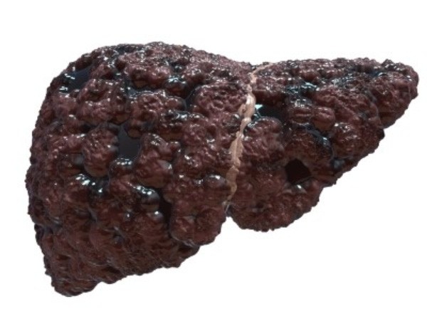 Nhiều người Việt gan cứng như đá vì hàng ngày nạp thứ đáng sợ này ảnh 1