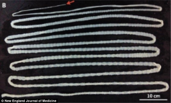 Kinh hoàng phát hiện con sán dài hơn 6m trong bụng người đàn ông ảnh 1