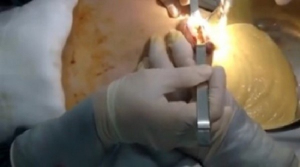 Hiểm họa khôn lường từ trào lưu bơm chất làm đầy vòng 1 ảnh 1