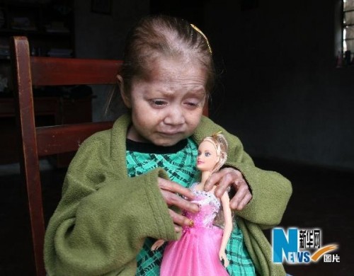 Đáng sợ căn bệnh biến trẻ thành cụ già ảnh 2