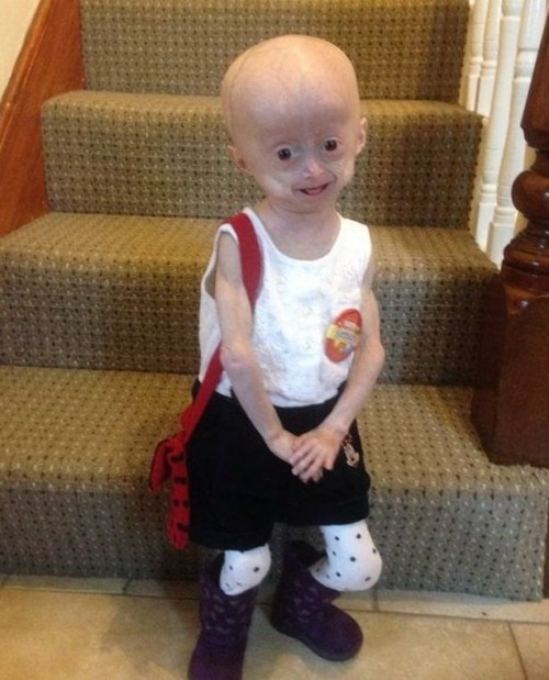 Đáng sợ căn bệnh biến trẻ thành cụ già ảnh 1