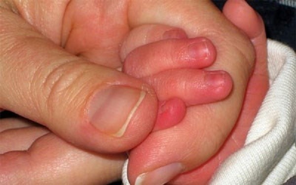 Cách phòng tránh và trị bệnh cước chân tay vào mùa đông ảnh 1