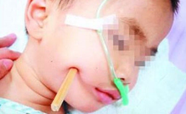 Vừa ăn cơm vừa xem hoạt hình, bé 2 tuổi bị đũa đâm vào hộp sọ ảnh 1