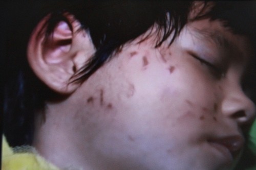 Bé 4 tuổi bị bạn cào rách mặt: 'Cần dạy trẻ ứng phó với bắt nạt' Bé 4 tuổi bị bạn cào rách mặt: 'Cần dạy trẻ ứng phó với bắt nạt'