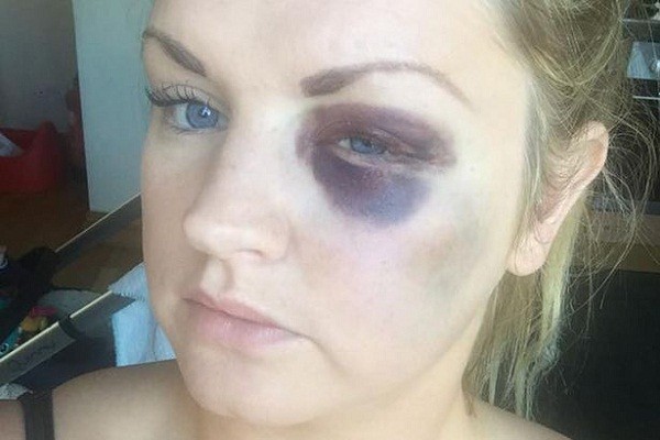 Cô dâu trả nhẫn trong ngày cưới vì chú rể đấm tím mắt 2 phù dâu ảnh 2