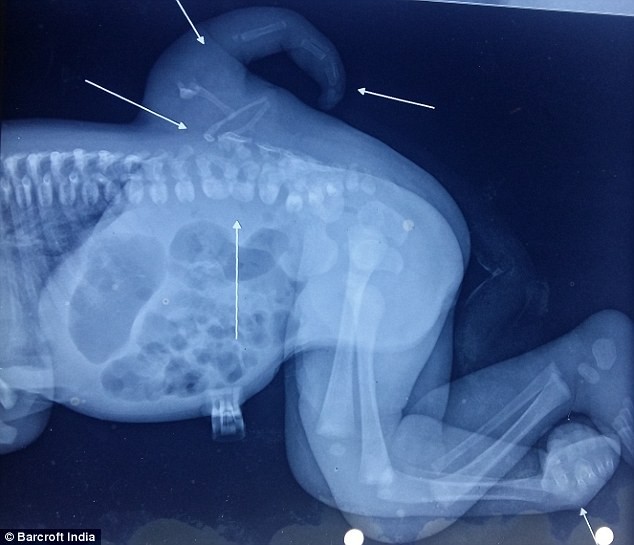 Kỳ lạ bé gái 2 tuổi mọc chân thứ 3 ở lưng ảnh 3