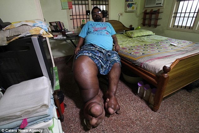 Chàng trai mắc bệnh lạ khiến chân to bằng một con voi sơ sinh ảnh 1