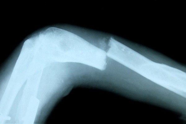 BS Harvard: Muốn không loãng xương, ngừng uống sữa! ảnh 1