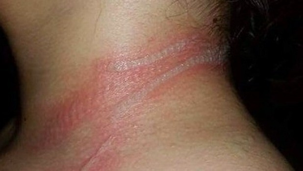 Gặp sự cố bất ngờ từ smartphone, bé gái mang sẹo cả đời ảnh 1