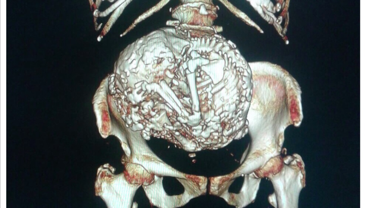 60 năm thai nhi nằm trong bụng bà cụ 91 tuổi mà không biết ảnh 2