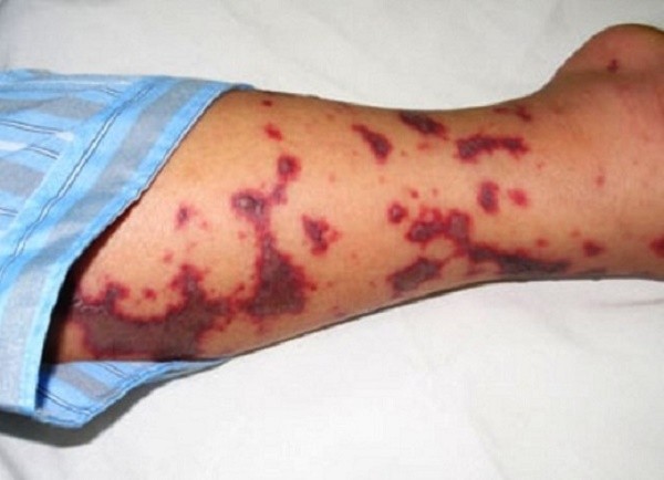 Dịch bệnh nguy hiểm viêm màng não mô cầu và cách phòng bệnh ảnh 1