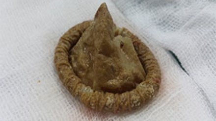 Giật mình phát hiện...bao cao su khi mổ lấy sỏi bàng quang ảnh 1