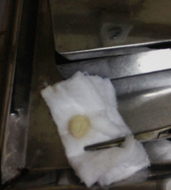 Bé 2 tuổi tử vong do hóc kẹo: BV không được phép mở khí quản? ảnh 2