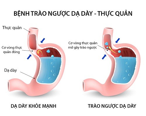 Bài thuốc Đông y chữa trào ngược dạ dày an toàn, hiệu quả ảnh 2