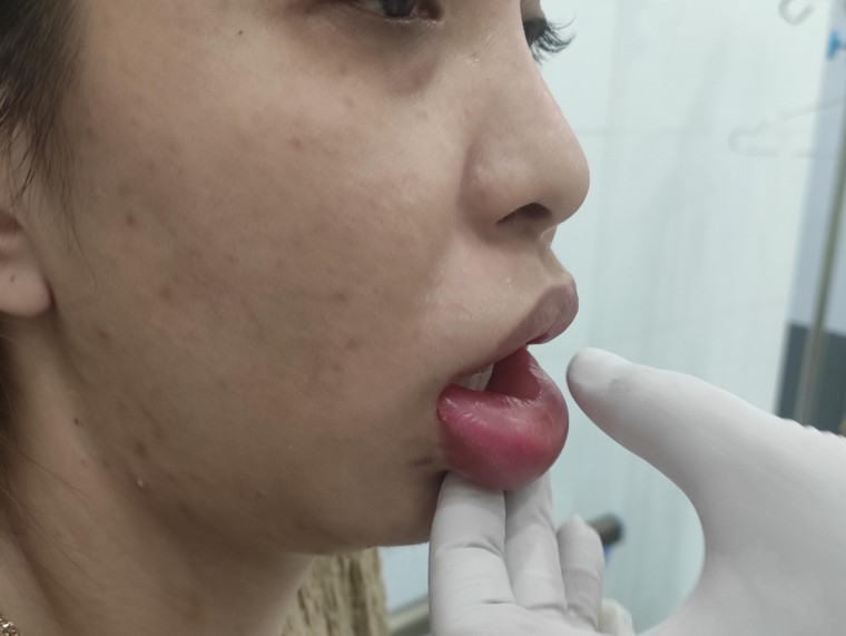 Môi sưng to như quả cà chua vì biến chứng sau tiêm filler không rõ nguồn gốc ảnh 1