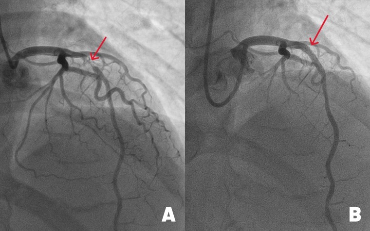 Nhập viện mổ ruột thừa, phát hiện thiếu máu nuôi tim suýt đột tử ảnh 1
